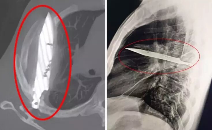 Göğüs ağrısıyla hastaneye gitti, göğsünde 8 yıldır bıçakla yaşadığı ortaya çıktı!